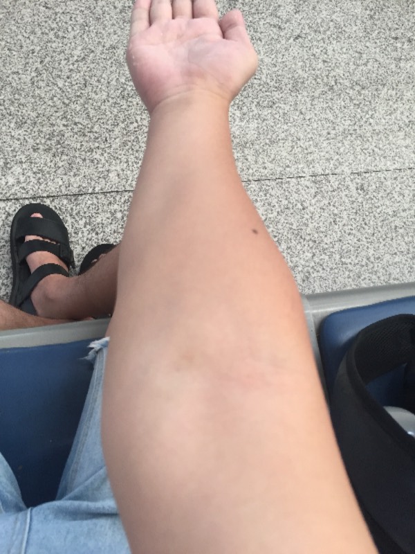 肘外翻20度,兵检过了,挑战与机遇并存,肘外翻20度,兵检通过的挑战与机遇并存之路