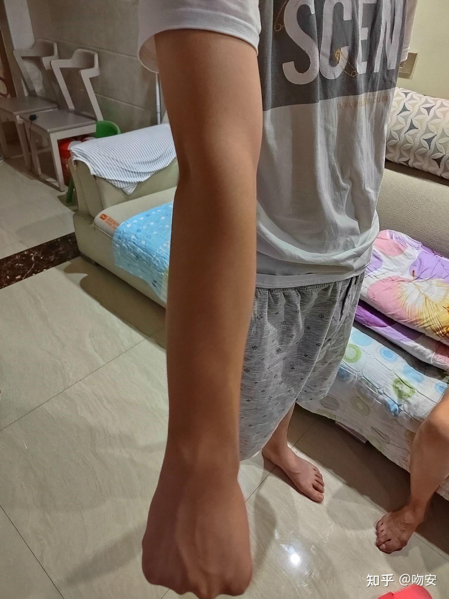 肘外翻20度,兵检过了,挑战与机遇并存,肘外翻20度,兵检通过的挑战与机遇并存之路