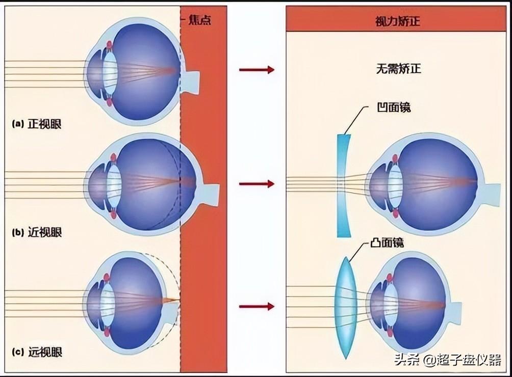 近视兵检过了是否需要激光手术，深度解析与探讨，近视兵检通过后是否需要激光手术，深度探讨与解析